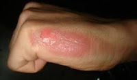 home remadies for burn skin in urdu
