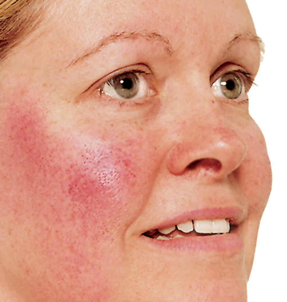 Rosaceawhat Is Rosaceasigns And Symptoms Of Rosacea Beauty Tips