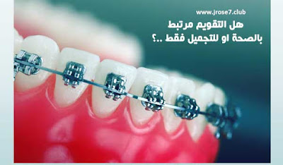 تقويم الاسنان اكثر من مجرد تجميل الوان تقويم الاسنان,انواع تقويم الاسنان,تقويم الاسنان,افضل تقويم اسنان,افضل معجون اسنان للتقويم