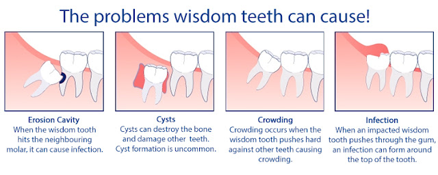 http://www.thangamsdentalclinic.org/wisdom-tooth-extraction.php