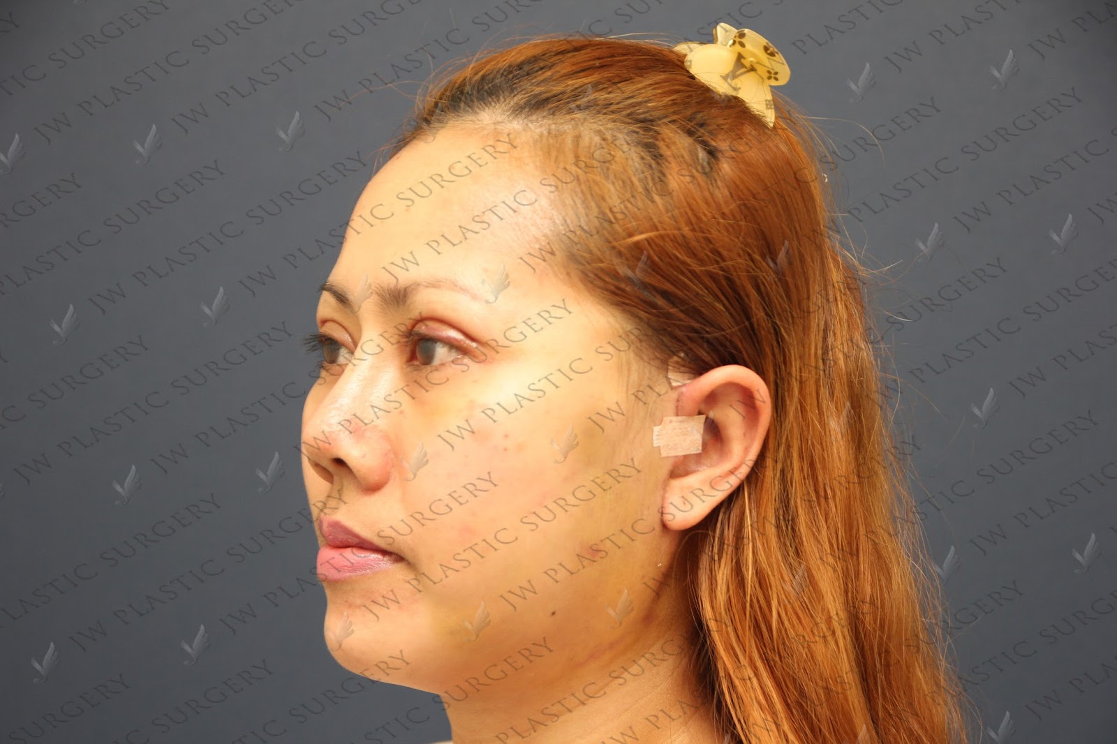 Face Lift By Made Double Eyelid Incision Accusculpt Lift Jowlneck