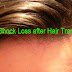 How typical is Shock Loss after Hair Transplant Surgery?