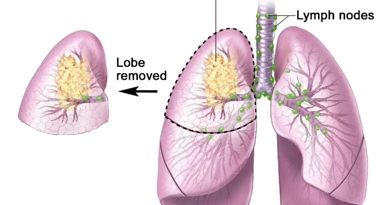 Stage 4 Non Small Cell Lung Cancer Life Expectancy CancerOz