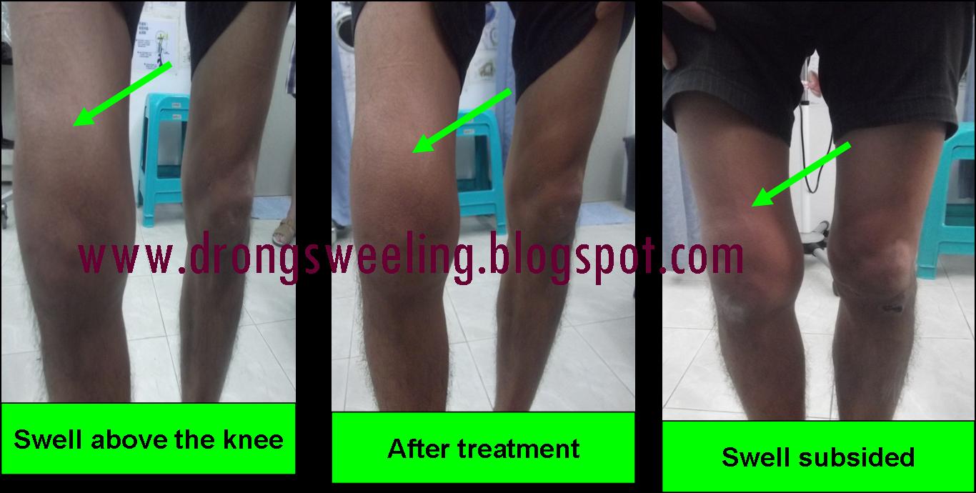 TCM News Best TCM Doctors Treat Knee Pain TCM Acupuncture