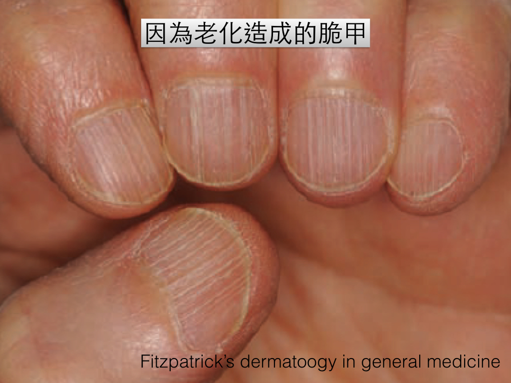 指甲專家 陳逸懃醫師: 為什麼我的指甲容易斷裂？塗再多指甲油都遮不住？淺談脆甲症