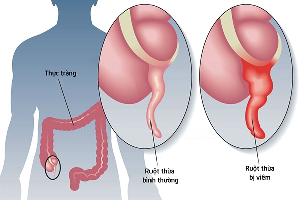Nghệ có tác dụng gì trong việc điều trị một số căn bệnh