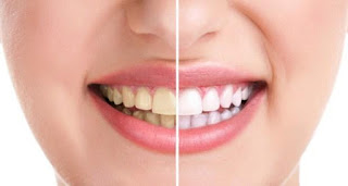 Tips for Yellow Teeth to Become White Daanto ke peelepan se chhutkara paane ke liye nuskhe