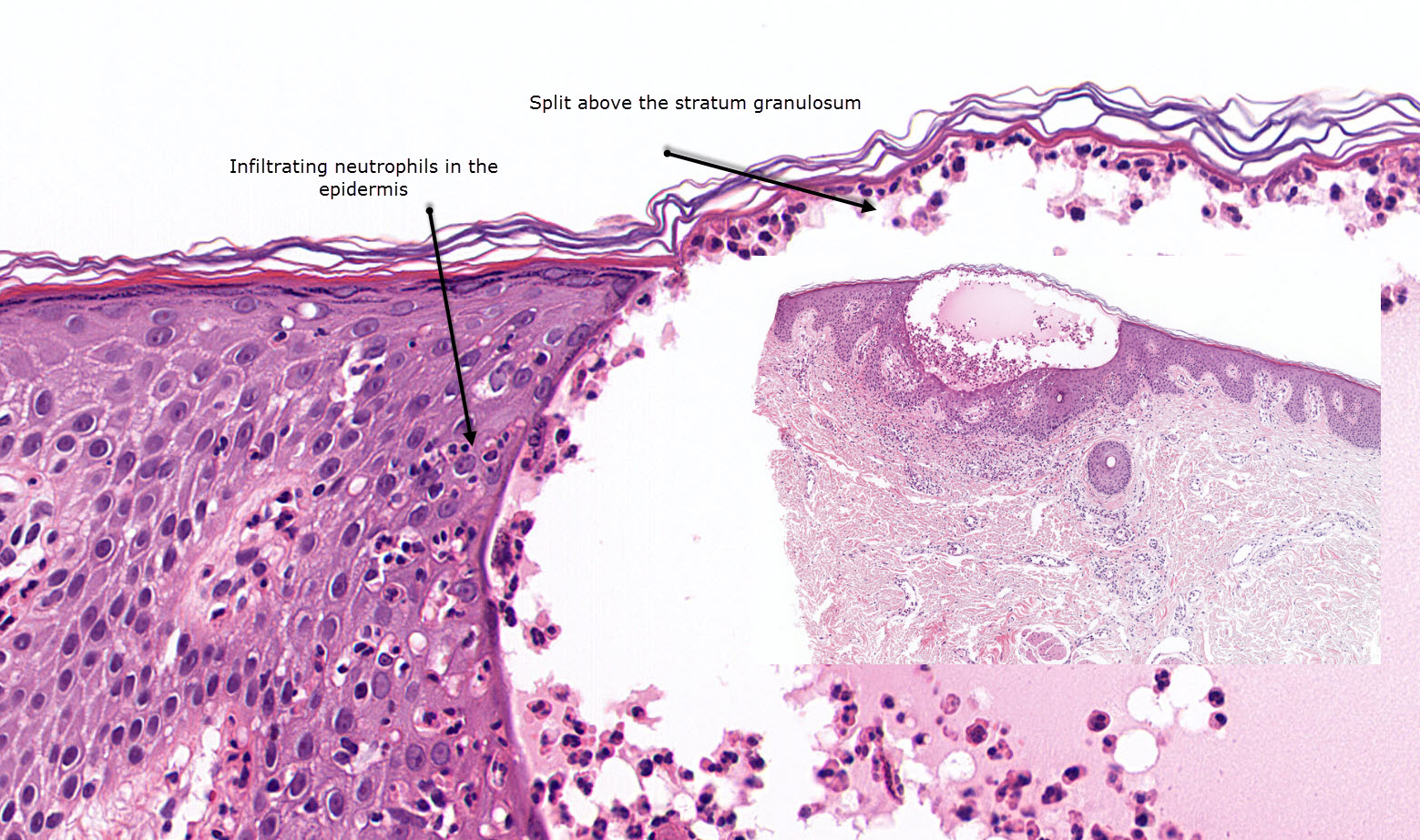 трубная беременность микропрепарат. внематочная гистология. внематочная гистология. неразвивающаяся беременность микропрепарат. децидуальная ткань гистология.