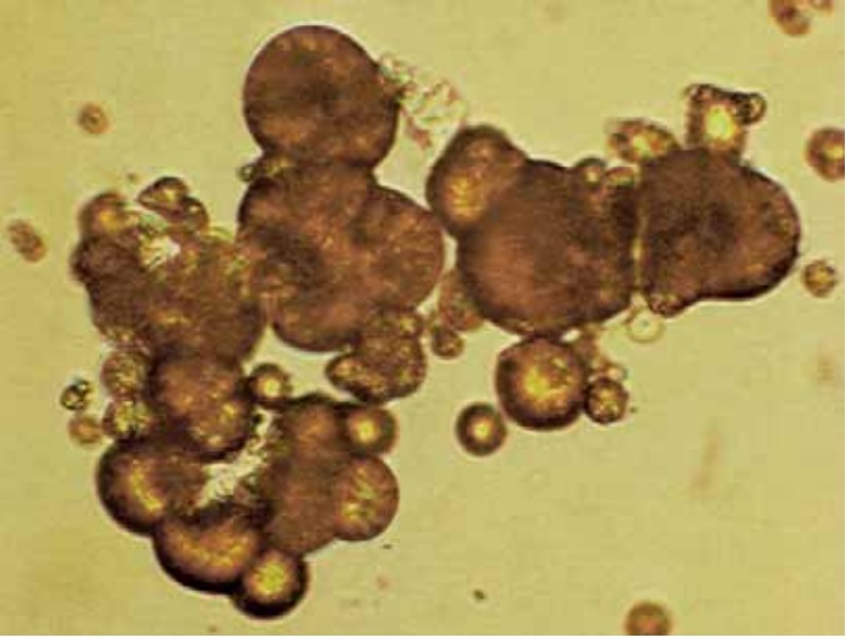 [Haematology] Microscopic Examination of Urinary Sediment Crystals
