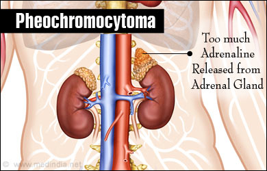pheochromocytoma