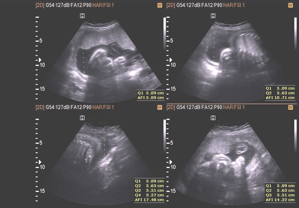 Pemeriksaan Ultrasonografi (USG) Trimester 2/3