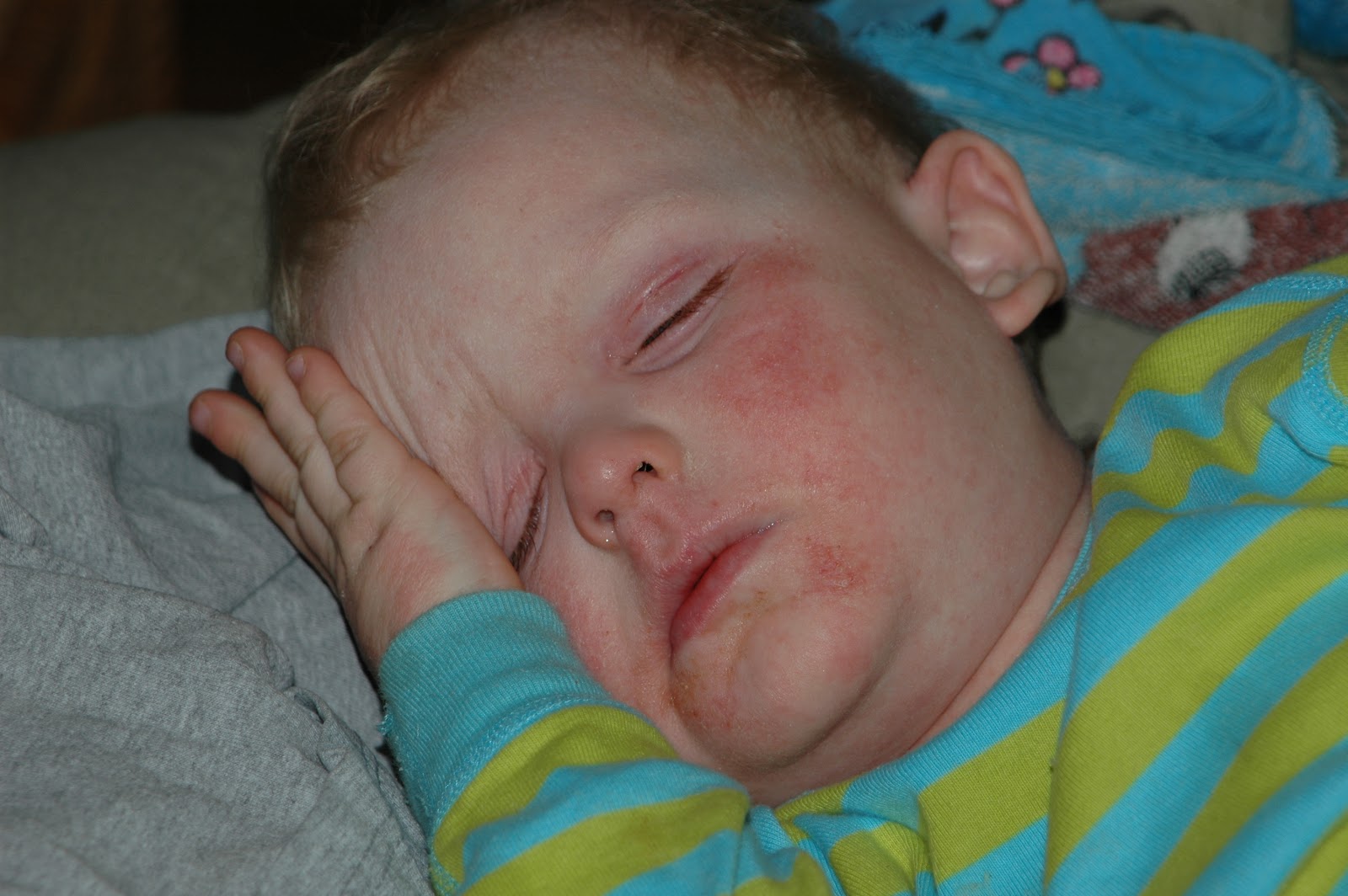 Kline's road from out of control eczema to topical steroid withdrawal