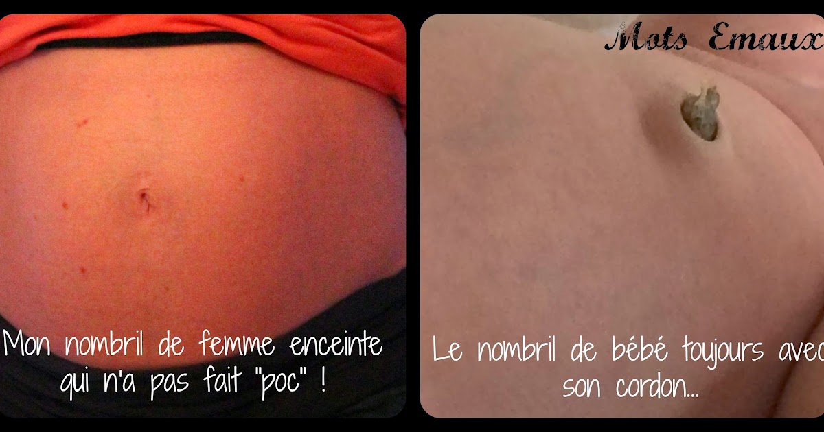 Celle qui avait la phobie des cordons et des nombrils qui font \