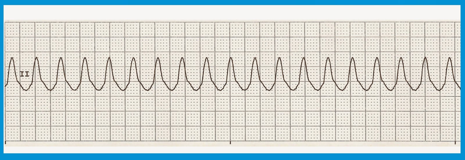 Practice EKG Strips 422