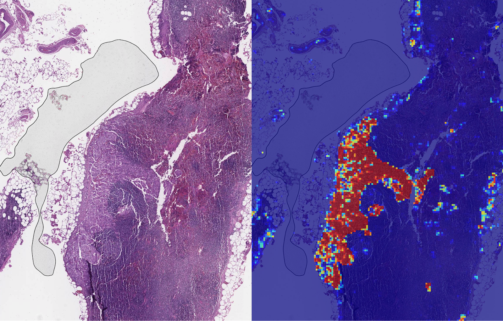 An AI-based breast cancer detector in action