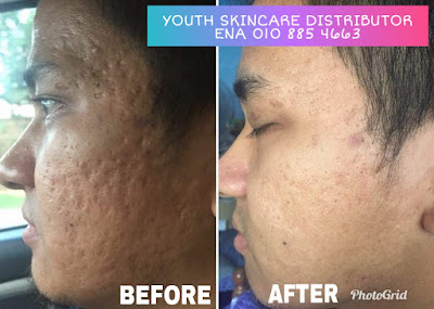 Bekas kawah jerawat hilang dan pudar dengan Youth Skincare Shaklee