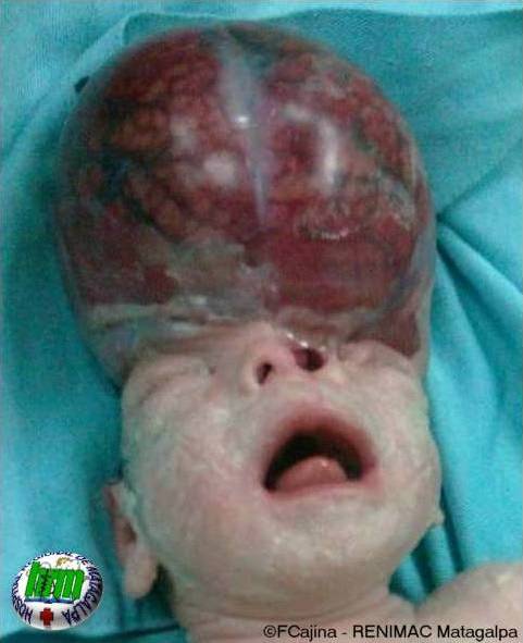 Macrosomia Fetale E Sindrome Di Down