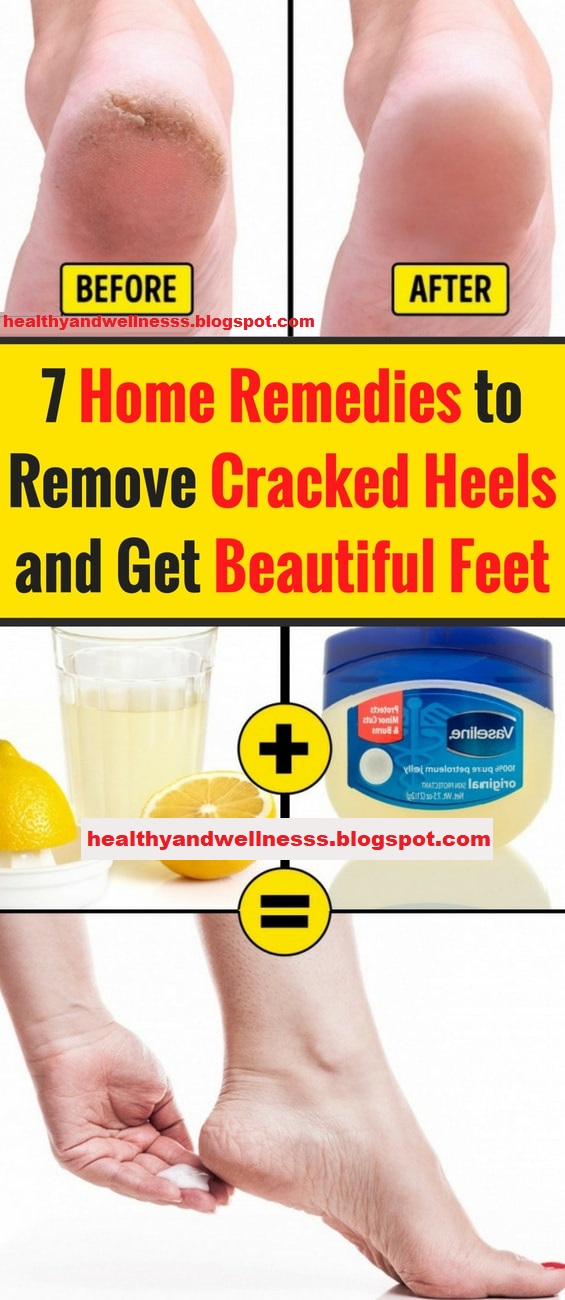 7 Home Remedies to Remove Cracked Heels and Get Beautiful Feet Health