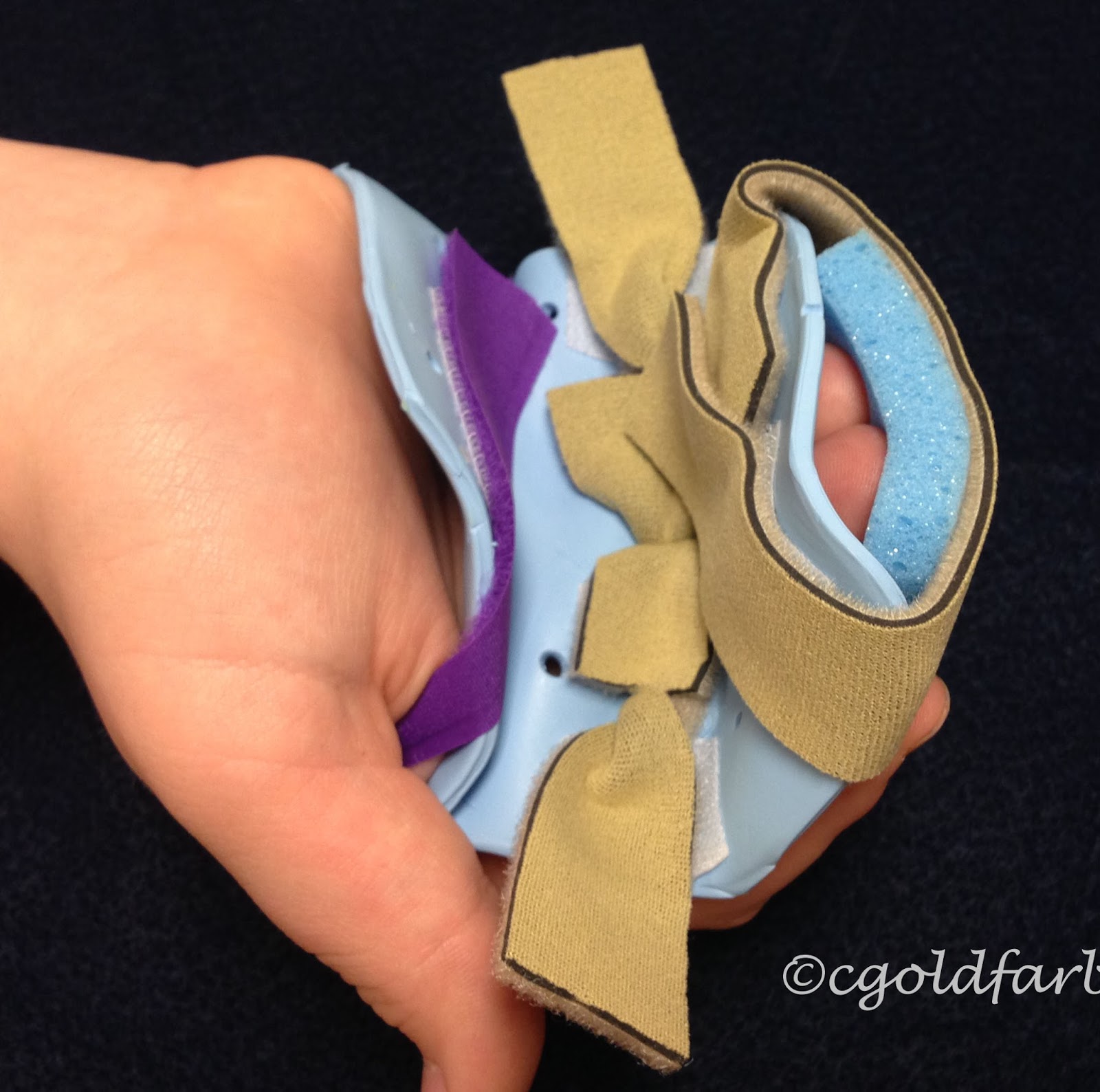 Camptodactyly bent finger treatment with splinting Congenital Hand