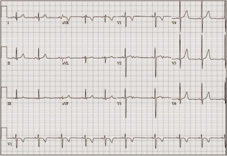 Everyday E(B)M: EKG Challenge No. 7 Case Conclusion - Not Everything is