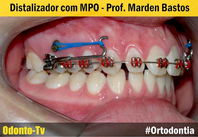 MICRO-PARAFUSOS ORTODÔNTICOS: Distalizador com MPO - Prof. Marden Bastos