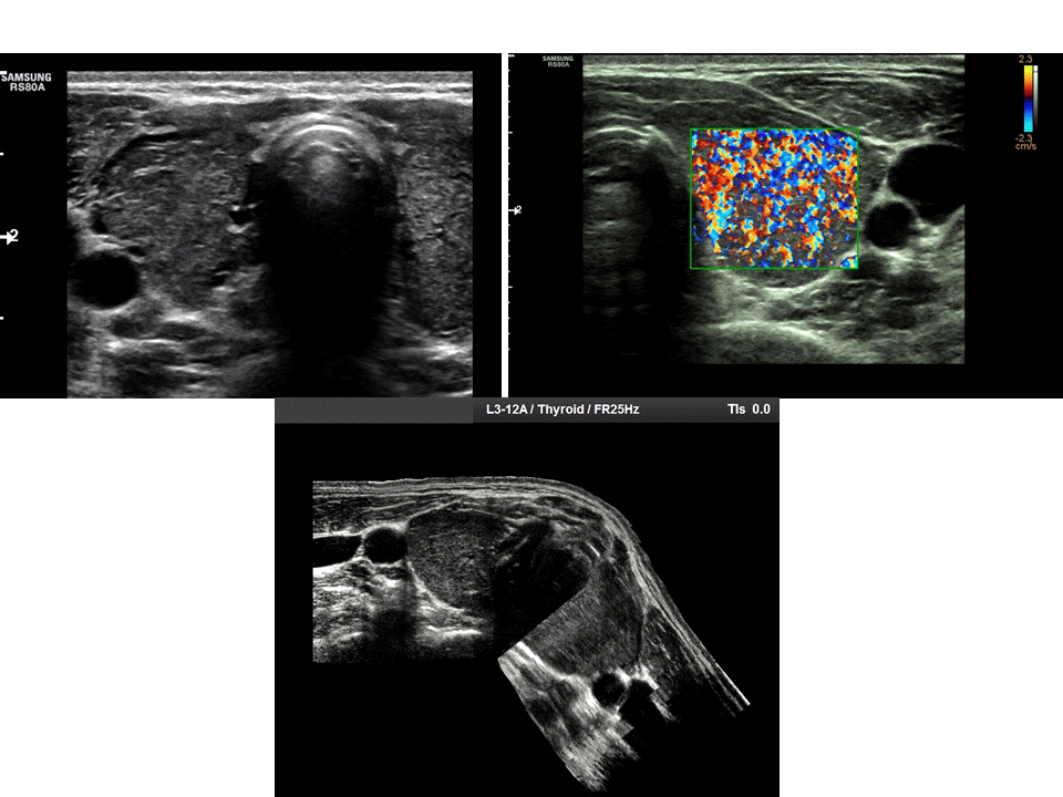 VIETNAMESE MEDIC ULTRASOUND CASE 317CT FIRST U/S SECOND IN CAUTION OF THYROID FUNCTION, Dr