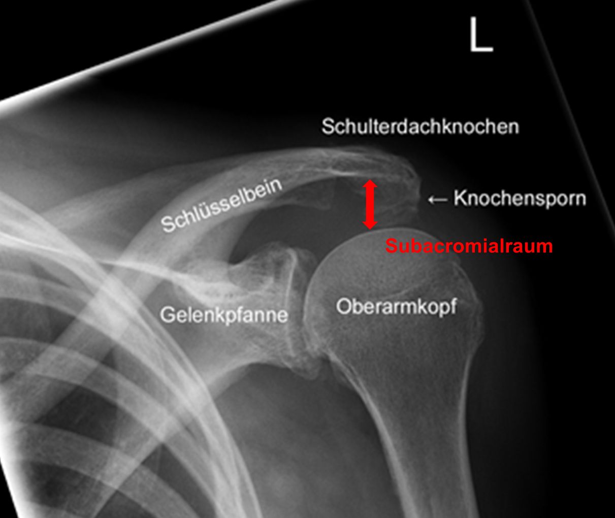 Импиджмент Синдром Плечевого Сустава Лечение — Buy-artox.ru