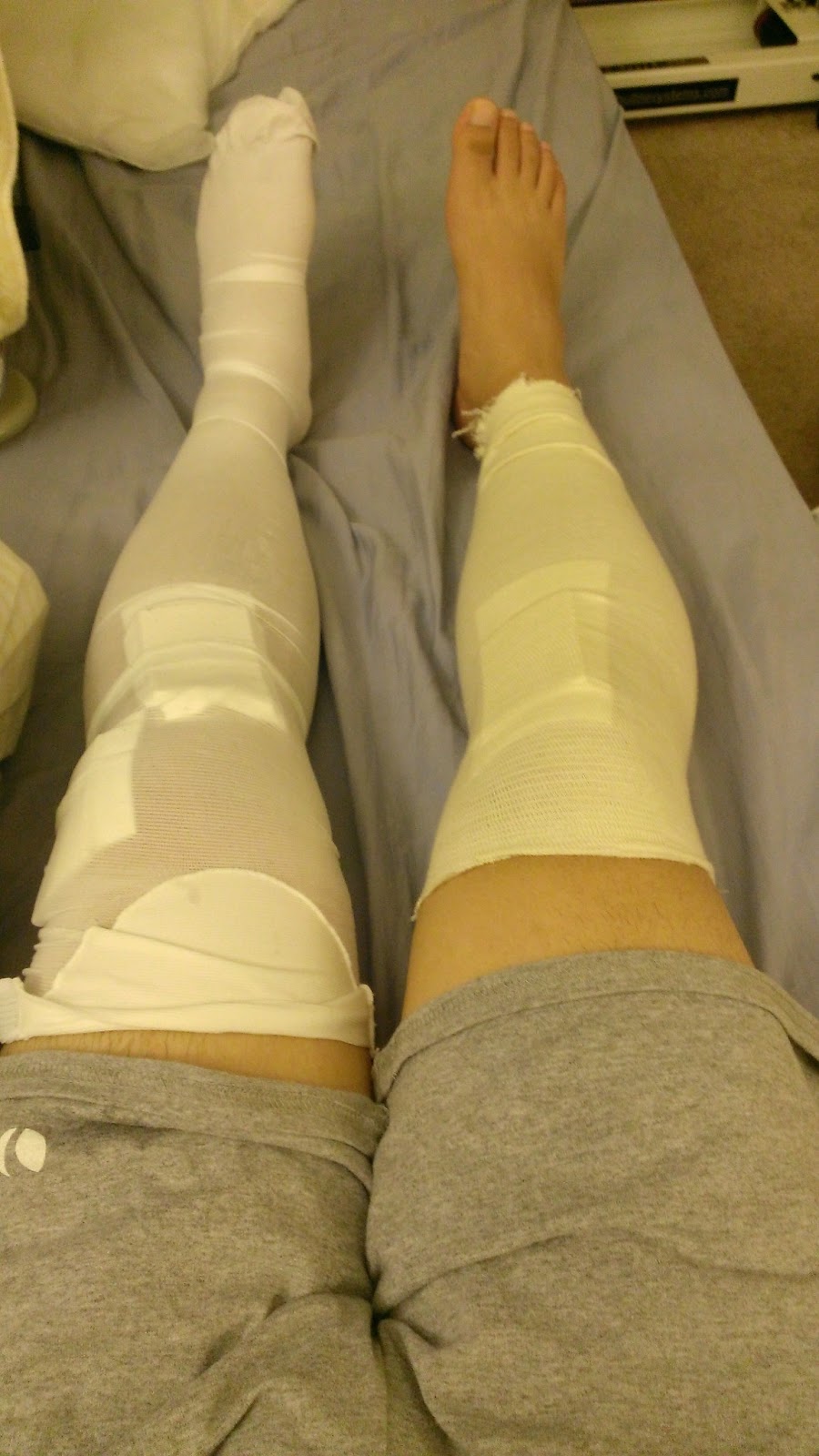 [WIP] ACL PostSurgery Week 2