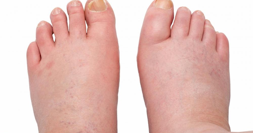 Tips to Reduce Swelling in Hands, Ankles and Feet