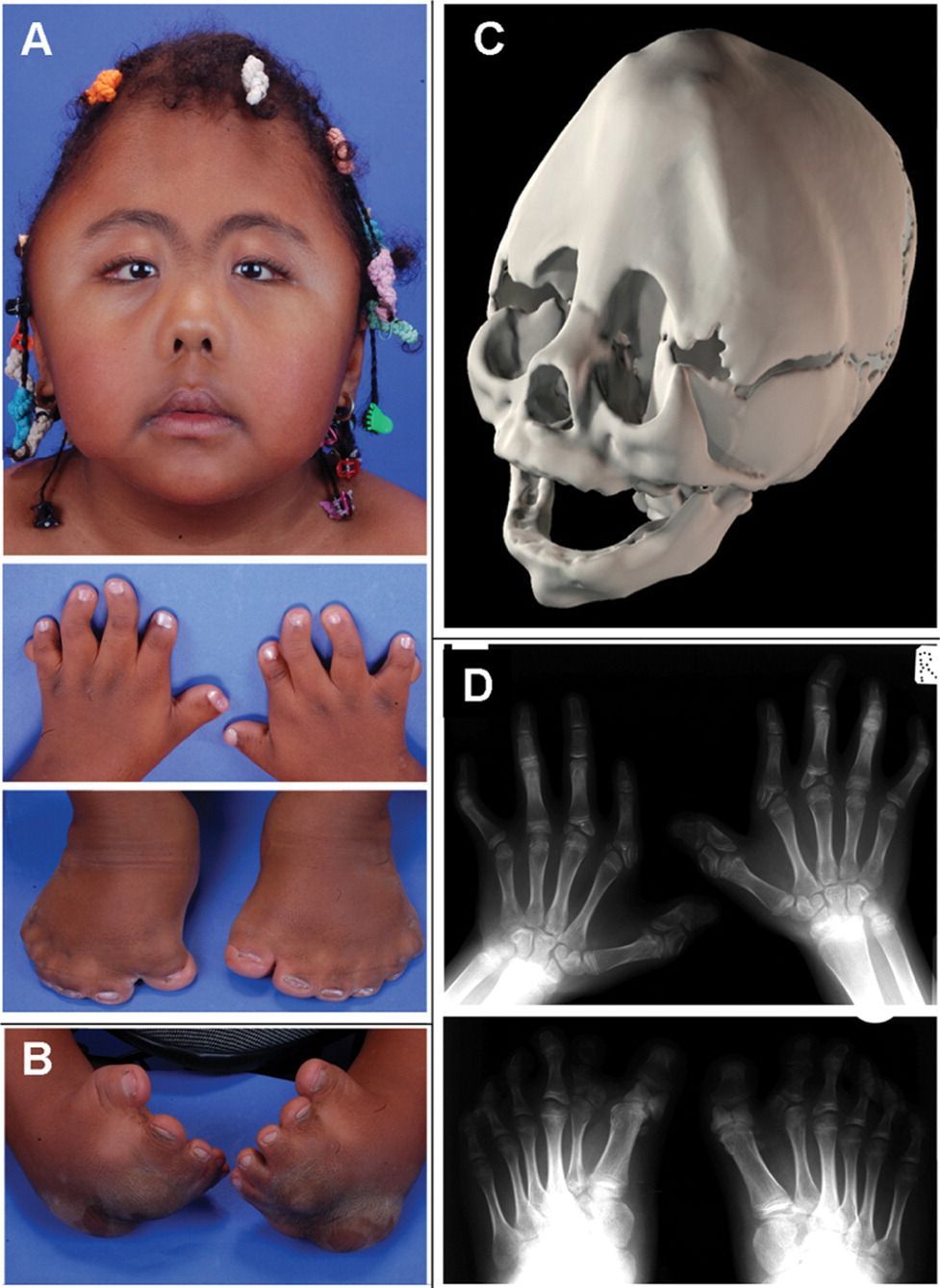 Préserver Ma Santé En Naturel Le Syndrome de Carpenter