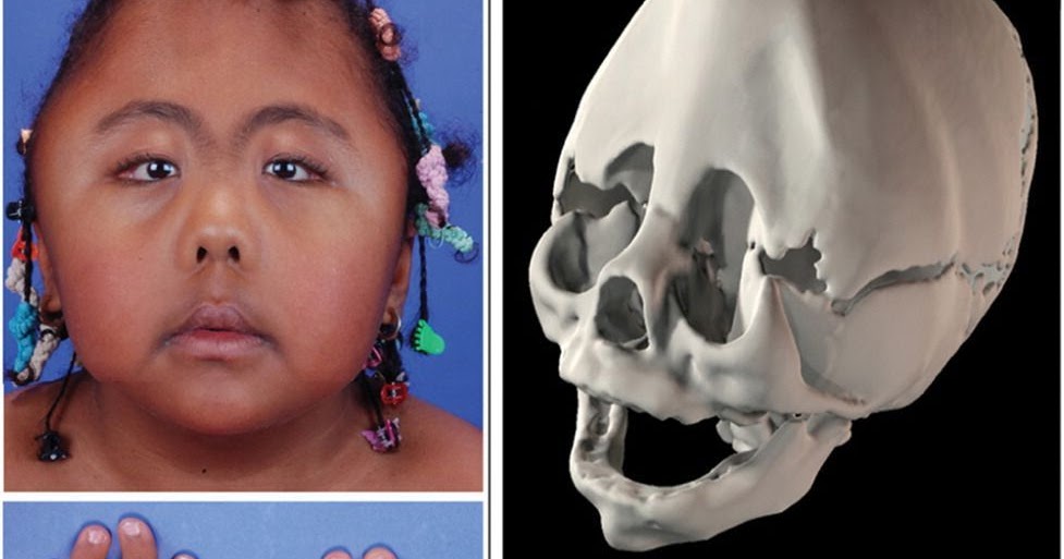 Préserver Ma Santé En Naturel Le Syndrome de Carpenter