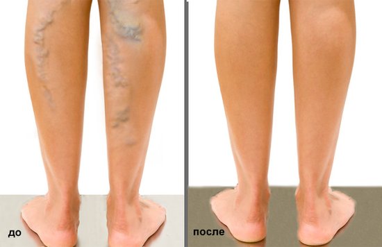 picături din venele varicoase cu castan simptome fotografia cu picioarele varicoase