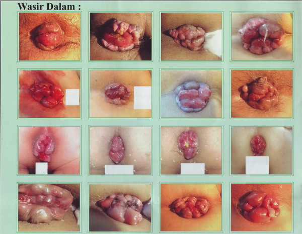 Ada Benjolan Di Lubang Dubur 