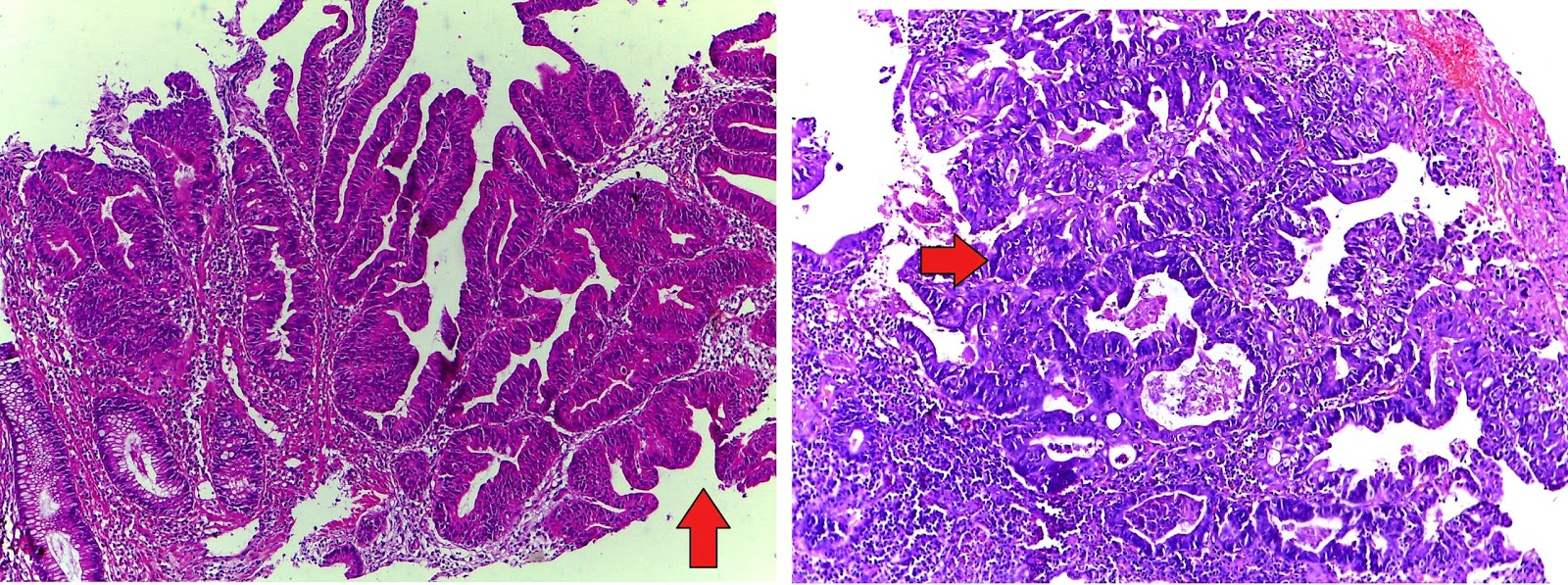 GASTROINTESTINAL AND LIVER HISTOLOGY PATHOLOGY ATLAS COLON ADENOCARCINOMA USUAL OR NOS TYPE GASTROINTESTINAL AND LIVER HISTOLOGY PATHOLOGY ATLAS COLON ADENOCARCINOMA USUAL OR NOS TYPE