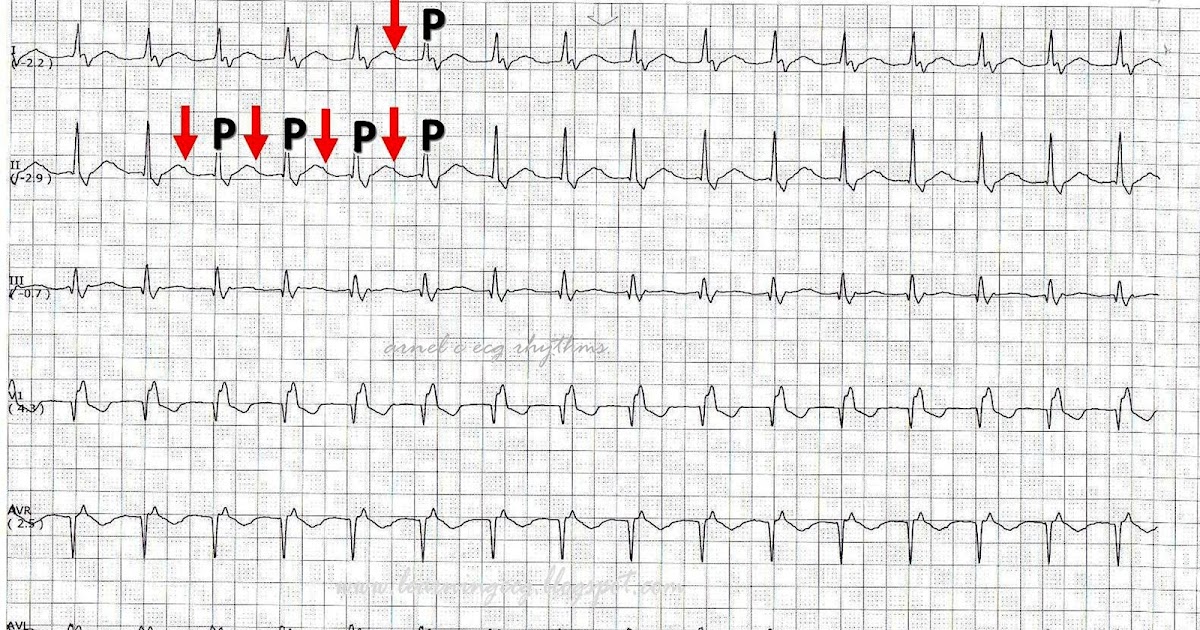 ECG Rhythms The Bix Rule