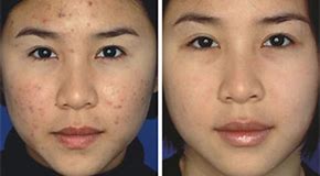 Cuantas Sesiones De Luz Pulsada Se Necesitan 2025