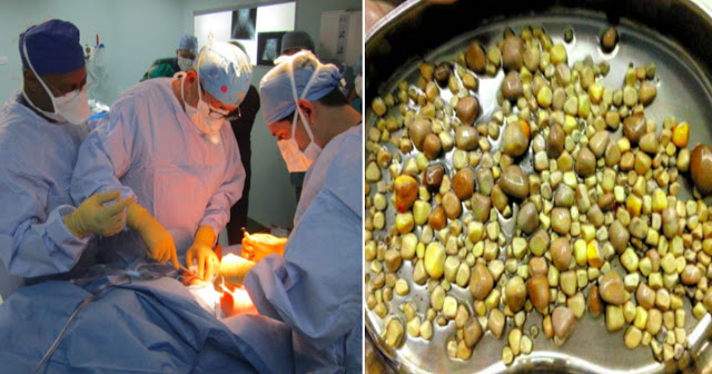 Lalaki nakuhanan ng 420 Kidney Stones matapos kumain ng ganitong uri ng pagkain