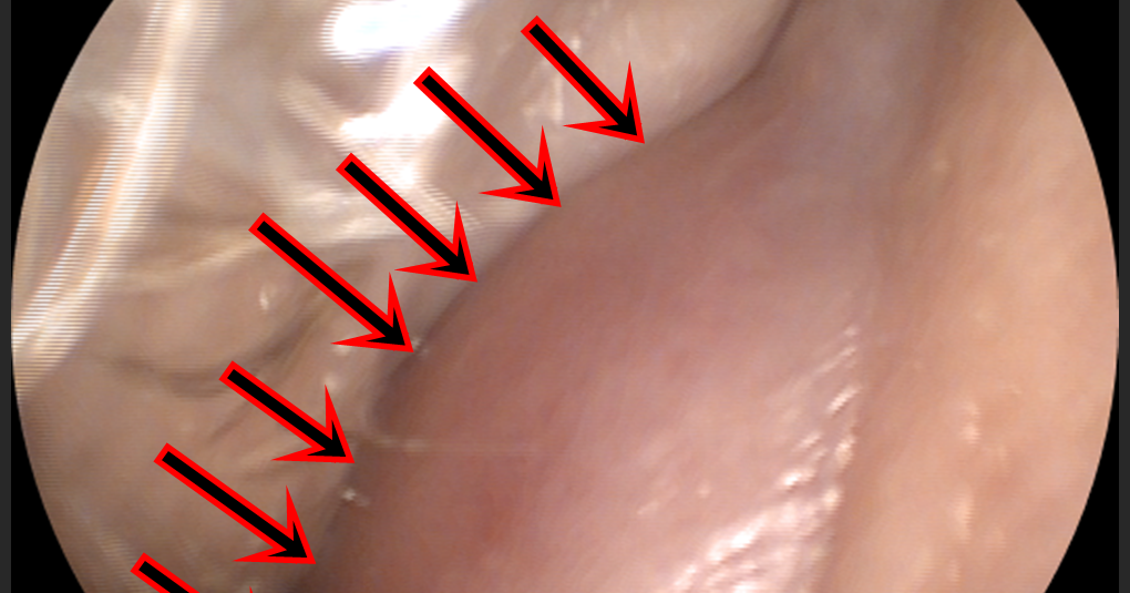 Nazal Septum Deviasyonu Tanımı, Belirtileri, Nedenleri ve Tedavisi