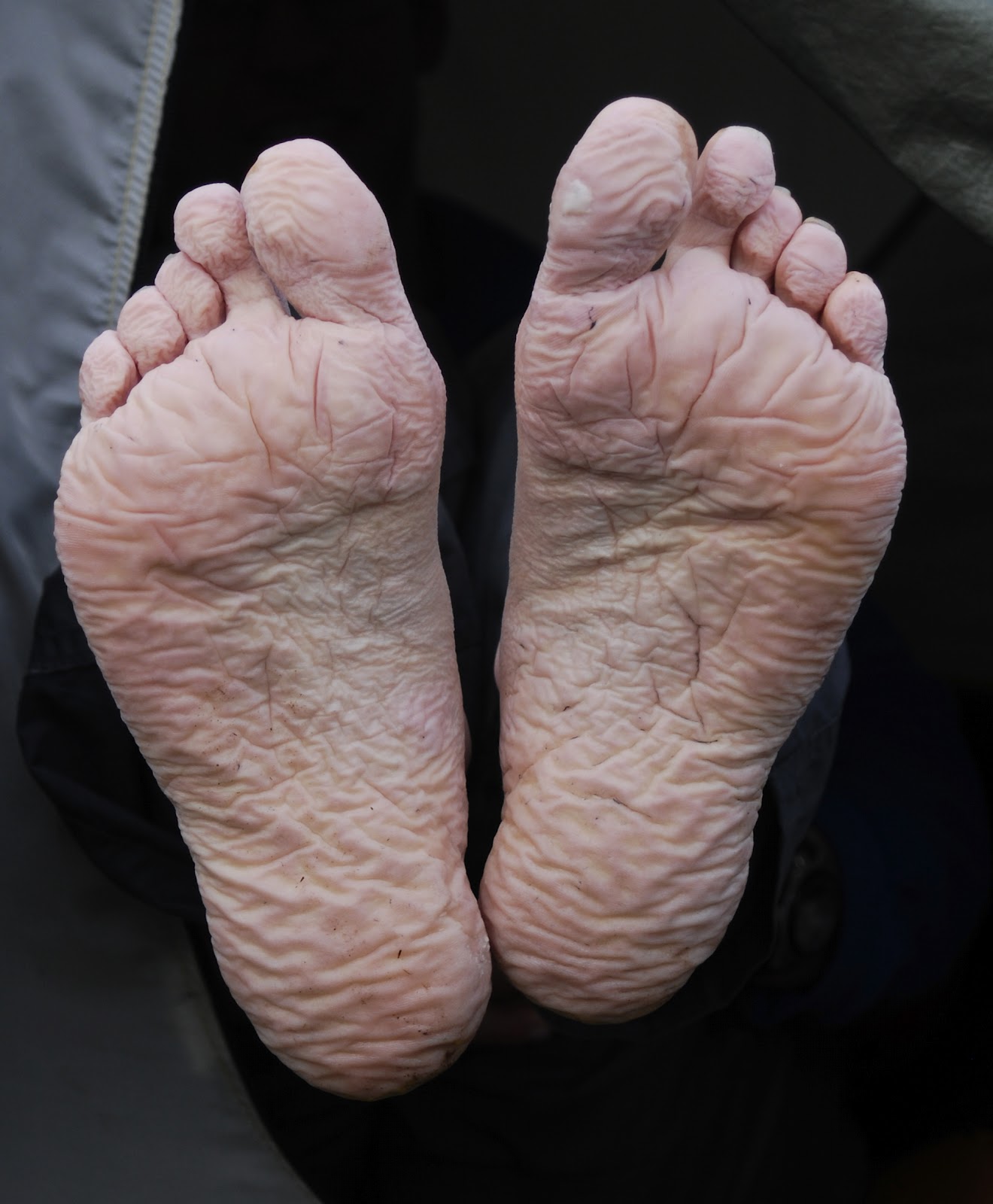 Deformutilation: Trench Foot