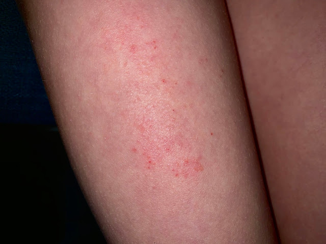 A patch of red angry skin on a child's legs