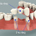 Thực hiện cách làm răng giả lúc mất 3 răng liên tục nhau