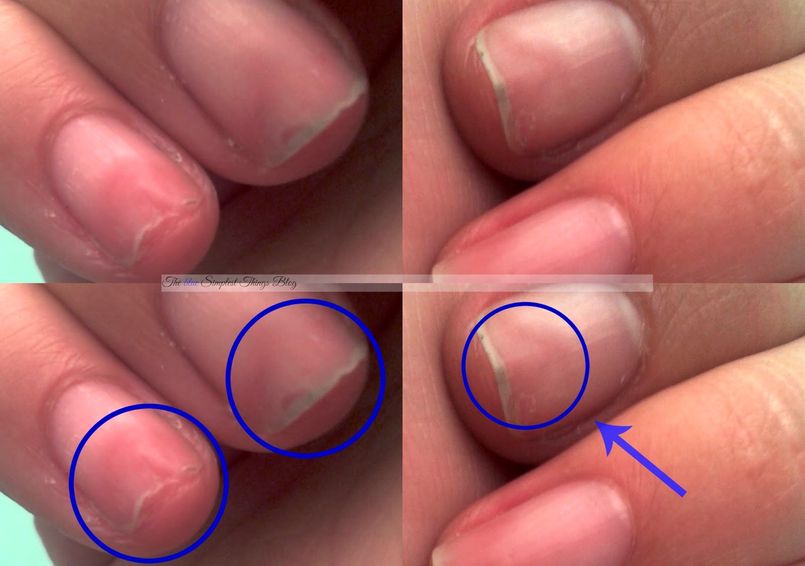Blue Simplest by Ailen: Como reparar daño profundo en las uñas