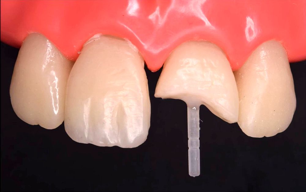 ENDODONCIA ¿Qué pasa después del tratamiento? Directorio Odontológico