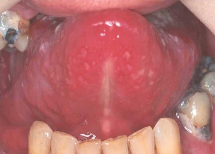 Recurrent aphthous stomatitis - PubMed Central (PMC)