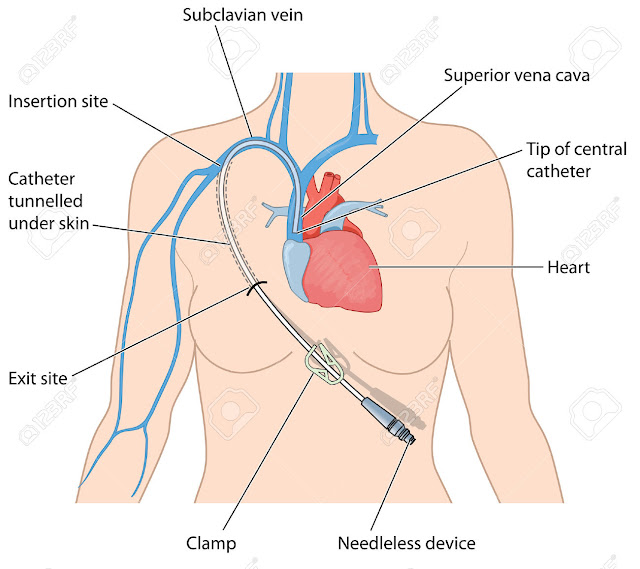 [Image: 46954771-Central-venous-catheter-and-nee...-Photo.jpg]