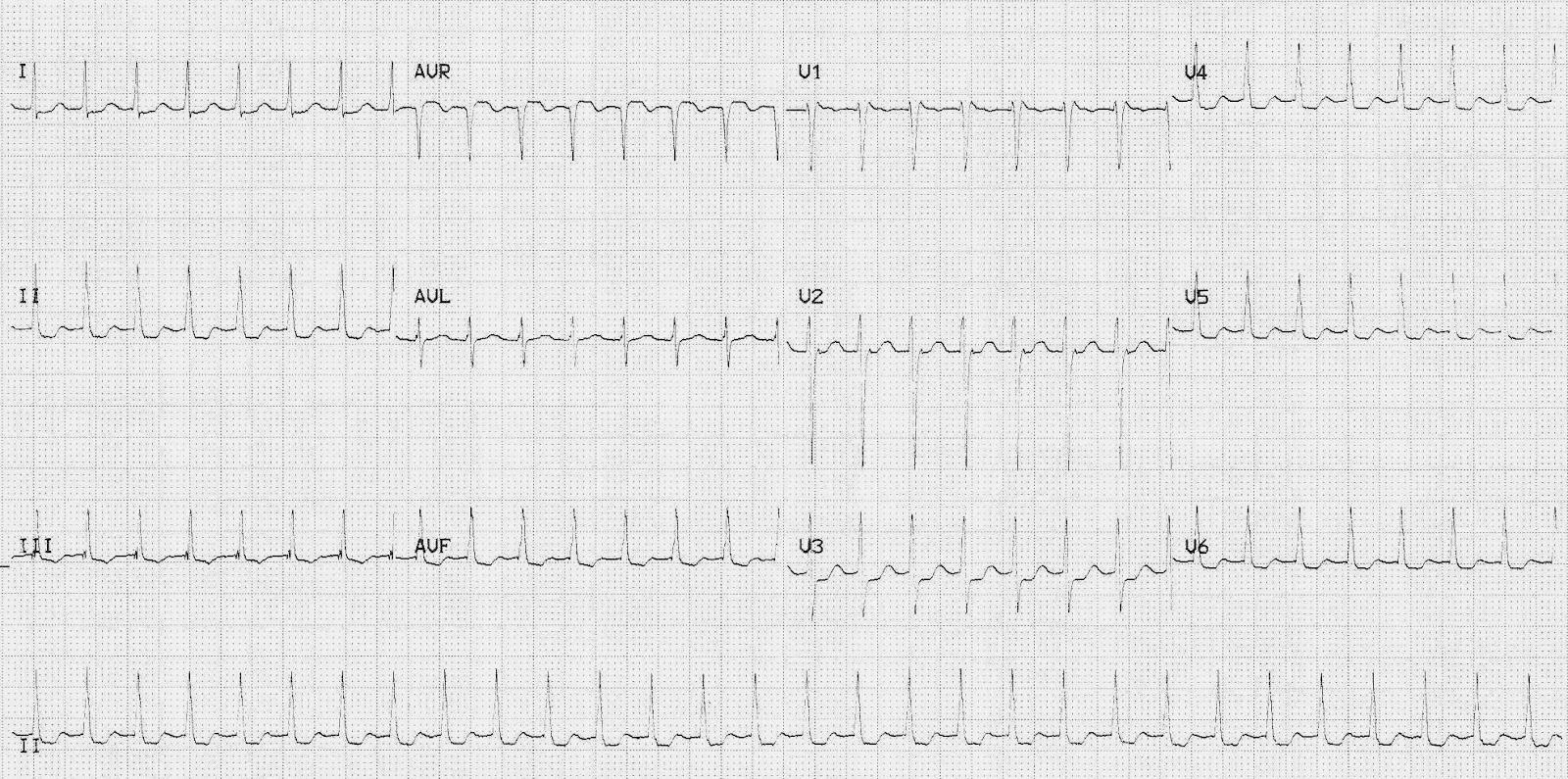 ECG of the Week ECG of the Week 21st May 2012