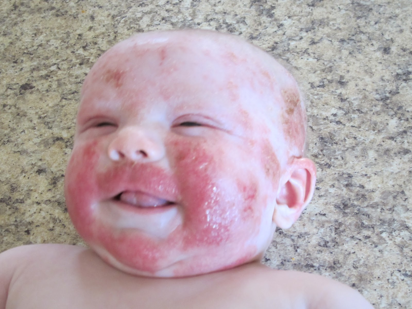 Adams Family Severe Allergy Induced Eczema On My Infant.