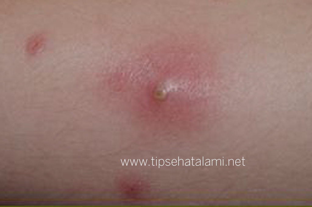 Cara Menghilangkan Penyakit Bisul Yang Kerap Muncul Berulang Kali