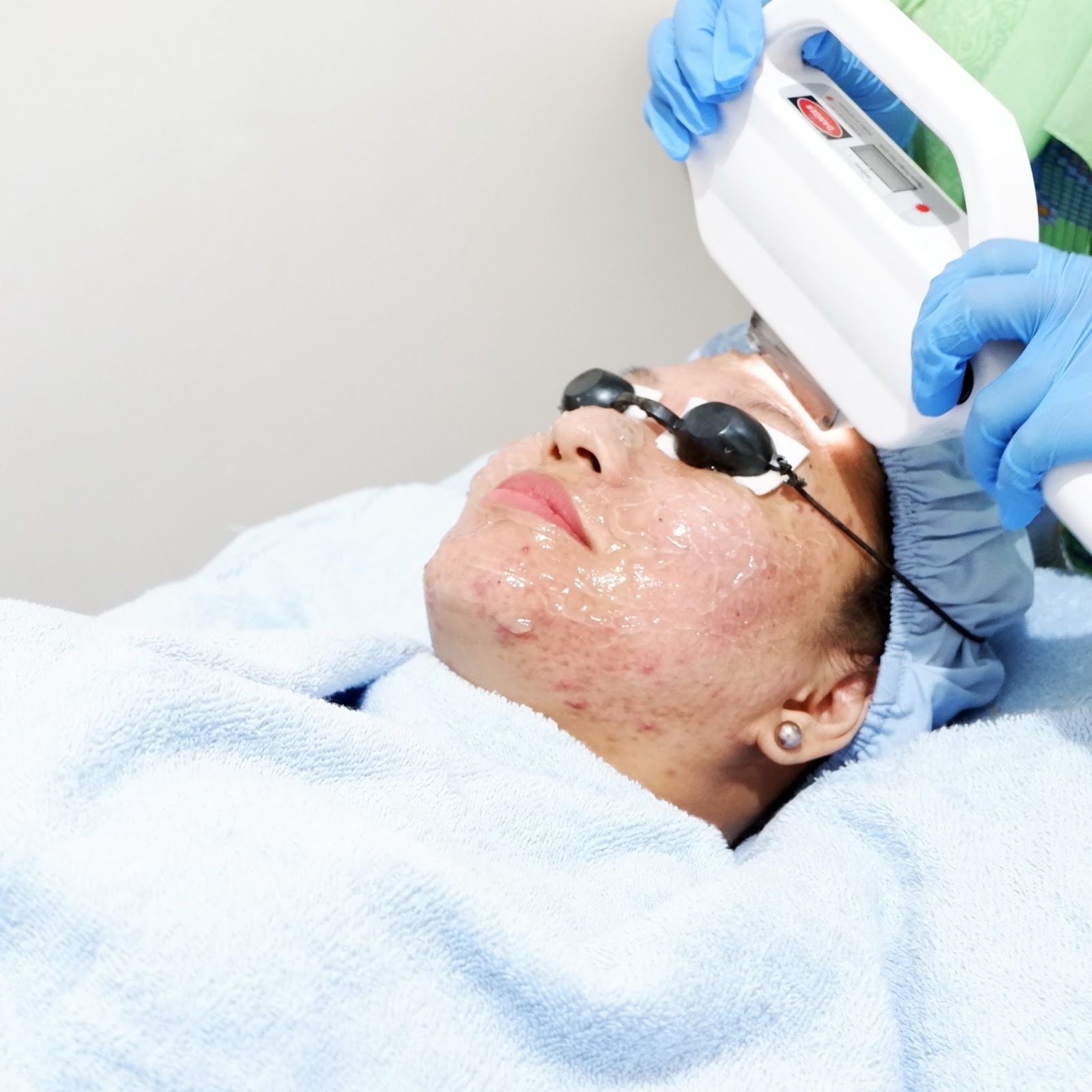 My First Acne Treatment With Karadenta Clinic Kiki Casmita