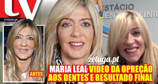 maria leal dentes novos implante dentário